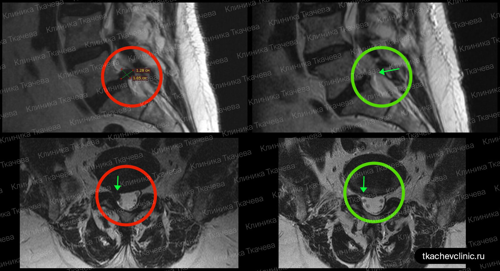 Лечение грыжи в пояснично-крестцовом отделе после 2,5 курсов резорбции ...