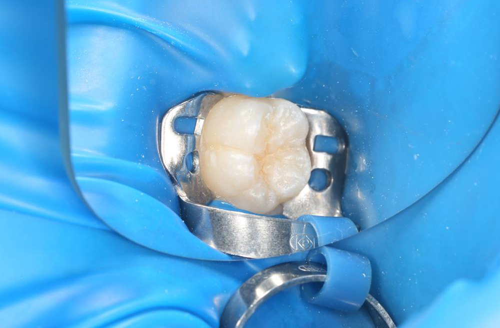 Герметизация фиссур первого постоянного моляра у шестилетней девочки с неудовлетворительной гигиеной