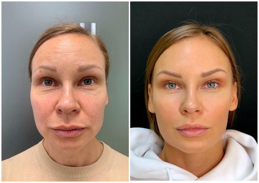 Smas лифтинг в Москве