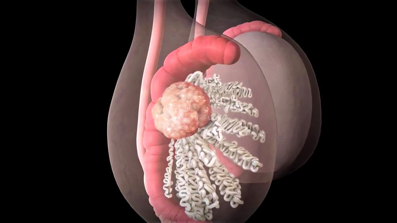 Рак яичек у мужчин. Лептогромия.
