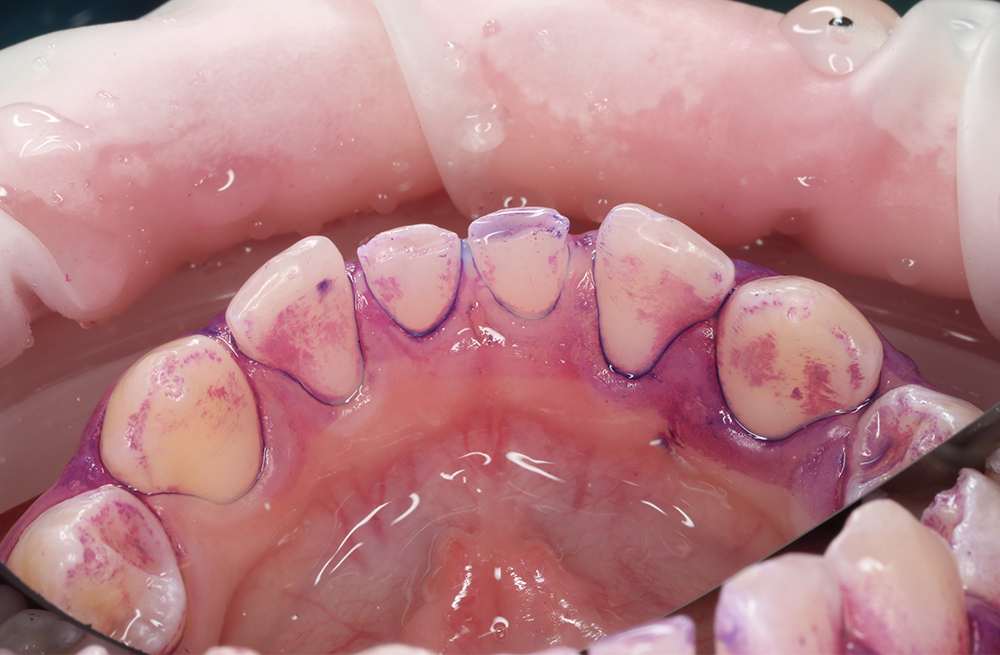 Плановая стоматологическая гигиена для подростка 12 лет