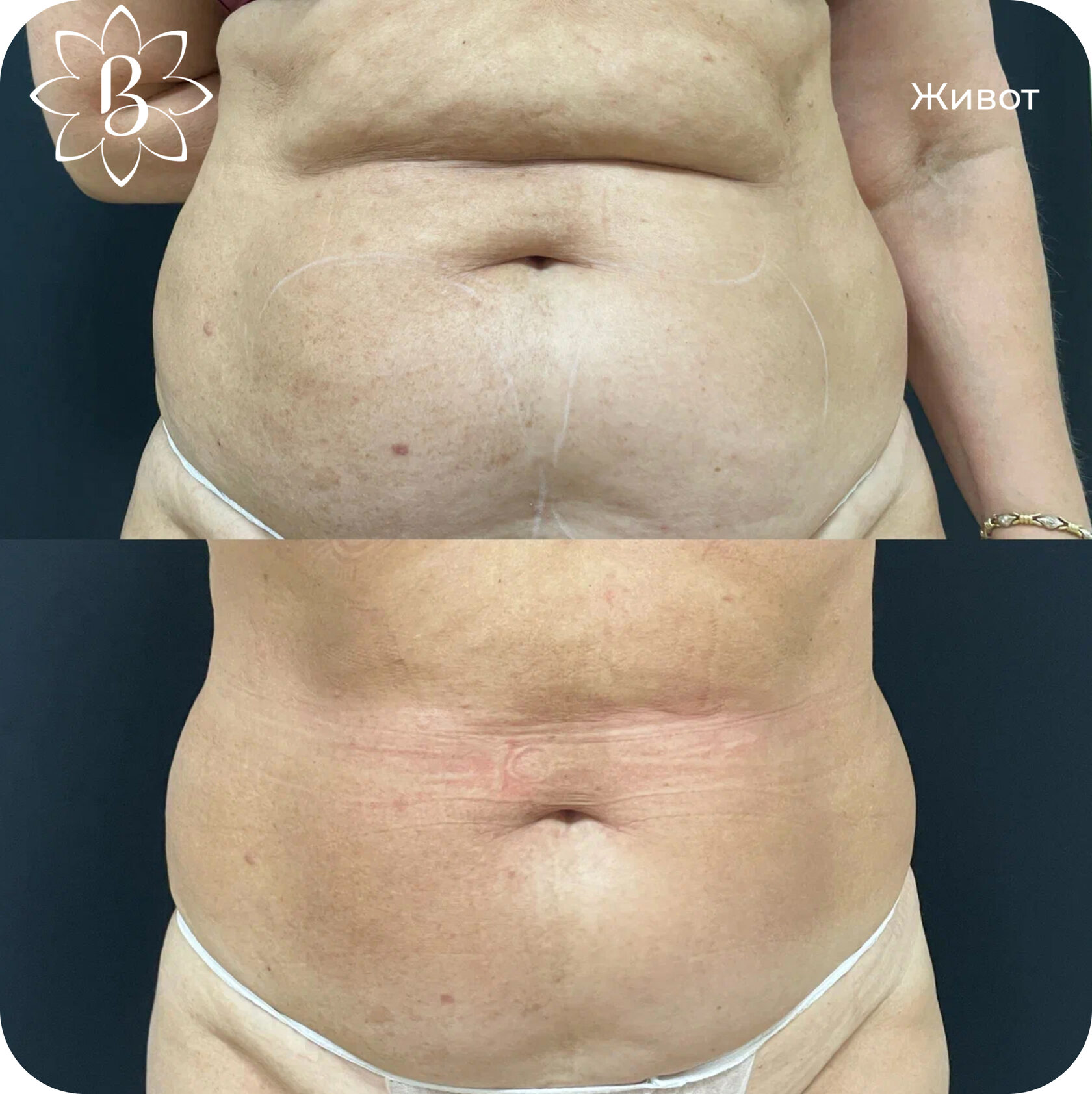 Диодная лазерная эпиляция СПб