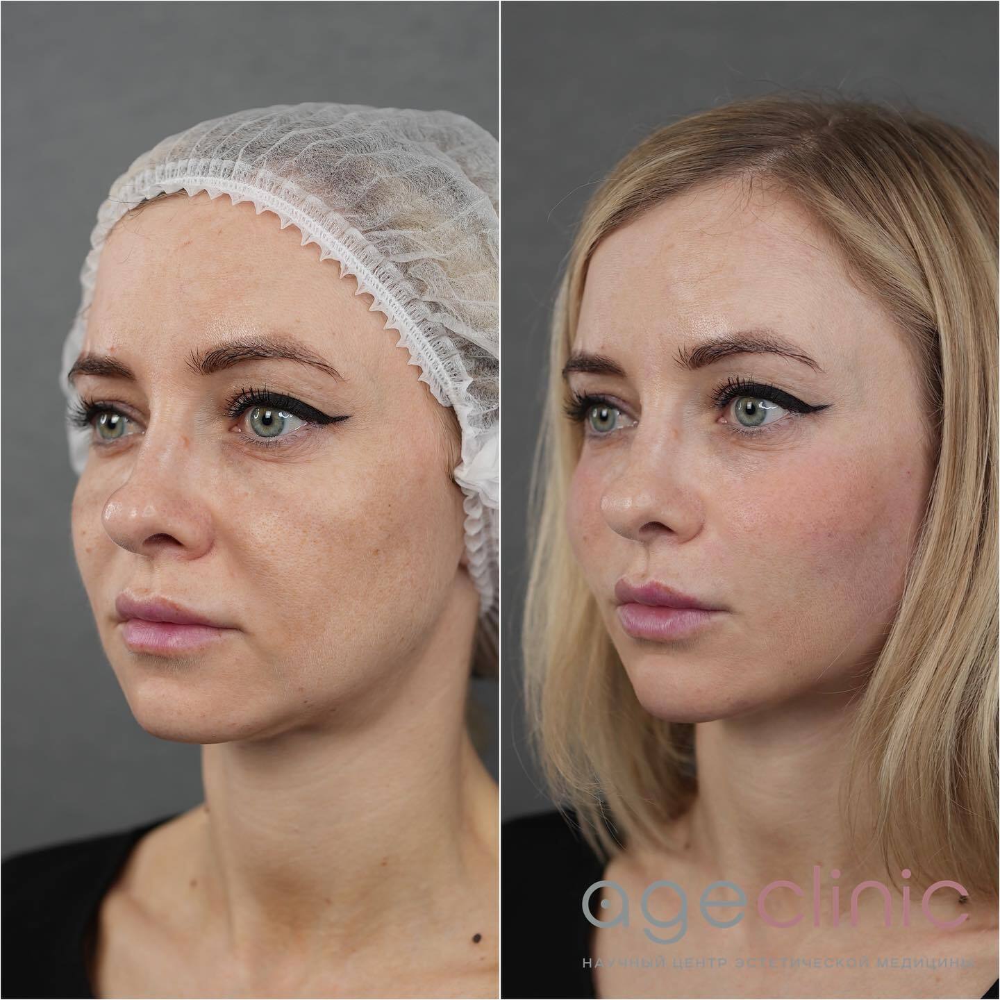 Ботокс фулфейс до и после. Фулфейс в косметологии. Фулфейс до и после. Как убрать второй подбородок косметология. Процедура фулфейс фото до и после.