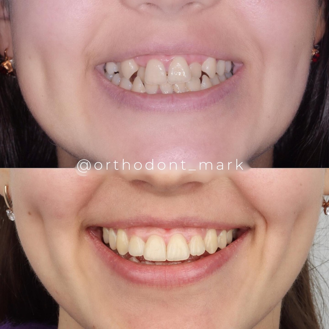 Resolving Severe Crowding and Midline Shift With Braces