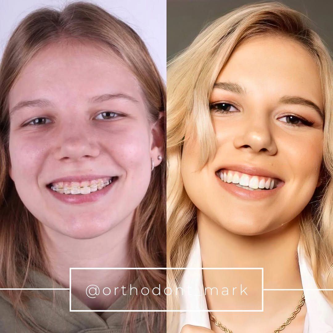 Before and after collage showing crossbite and crowding correction with a wide, even smile — photo 1 of 1