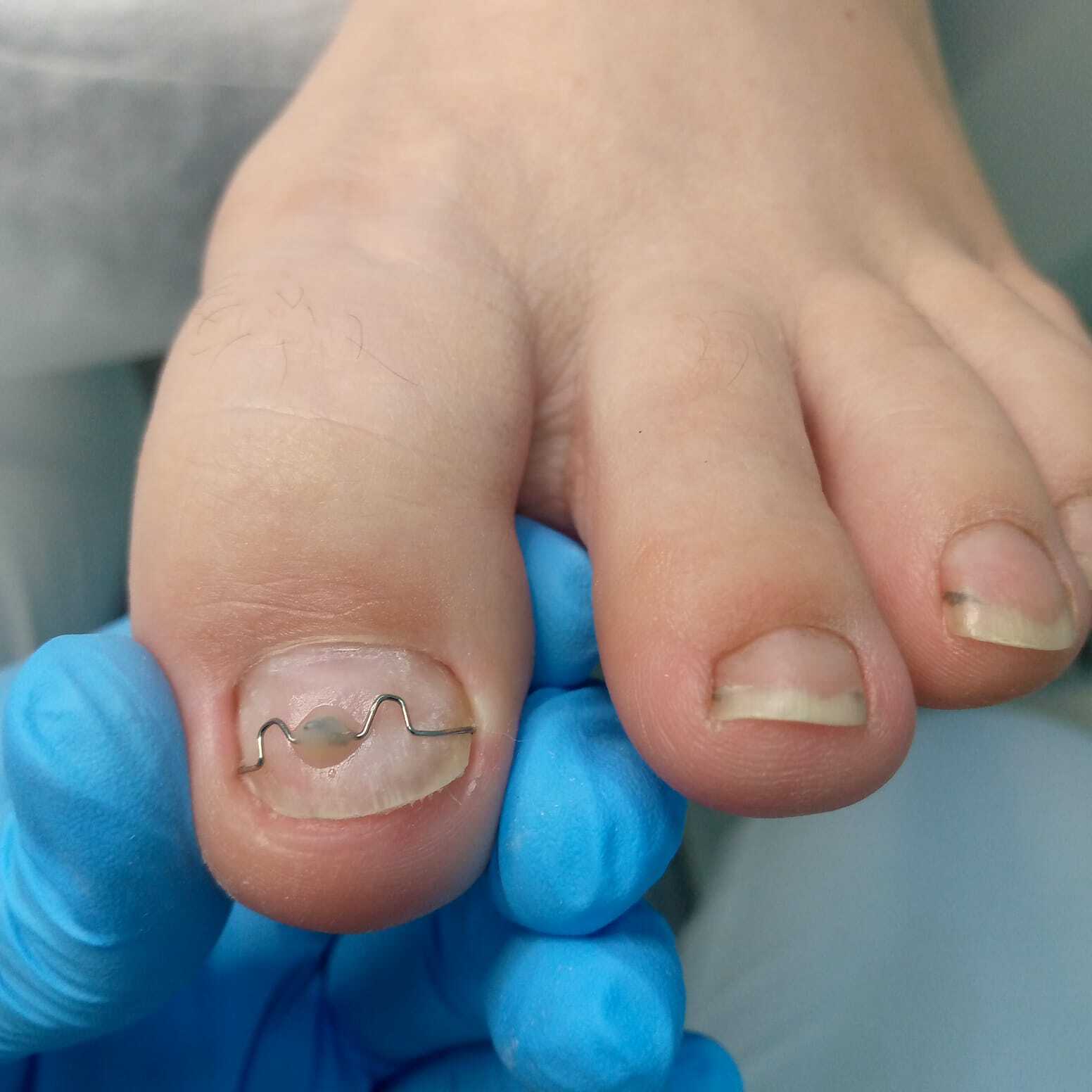 вросший ноготь на ноге, вросший ноготь, удаление вросшего ногтя, вросший ноготь лечение, вросший ноготь операция, удалить вросший ноготь, вросший ноготь цена