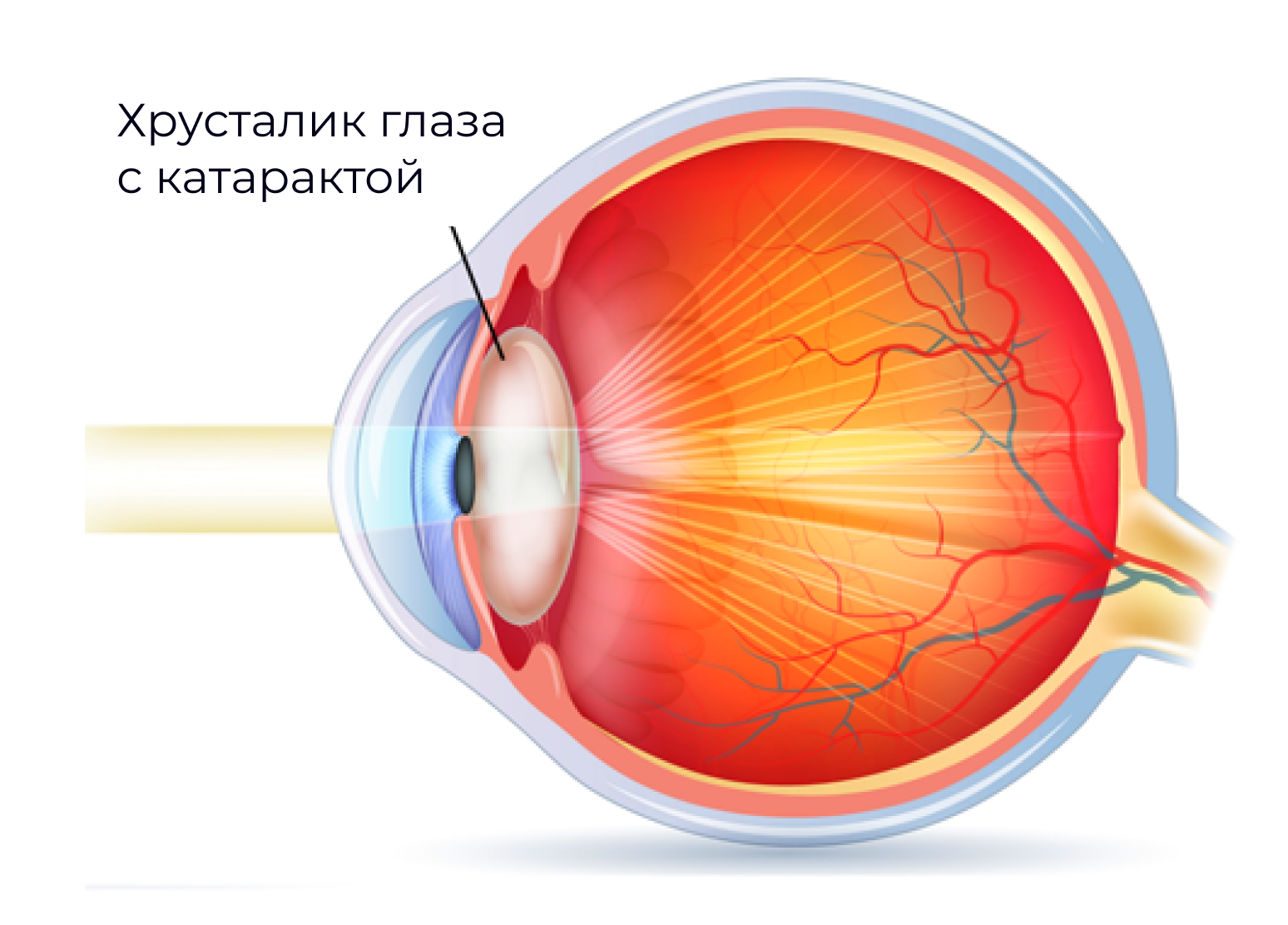 Катаракта глаза лучшие хрусталики. Миопическая катаракта. Помутнение хрусталика глаза.
