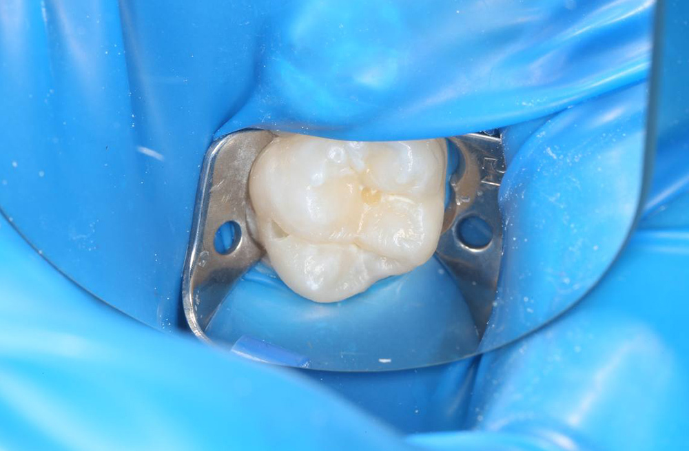Пломбирование кариозного дефекта коренного зуба с сохранением здоровых тканей