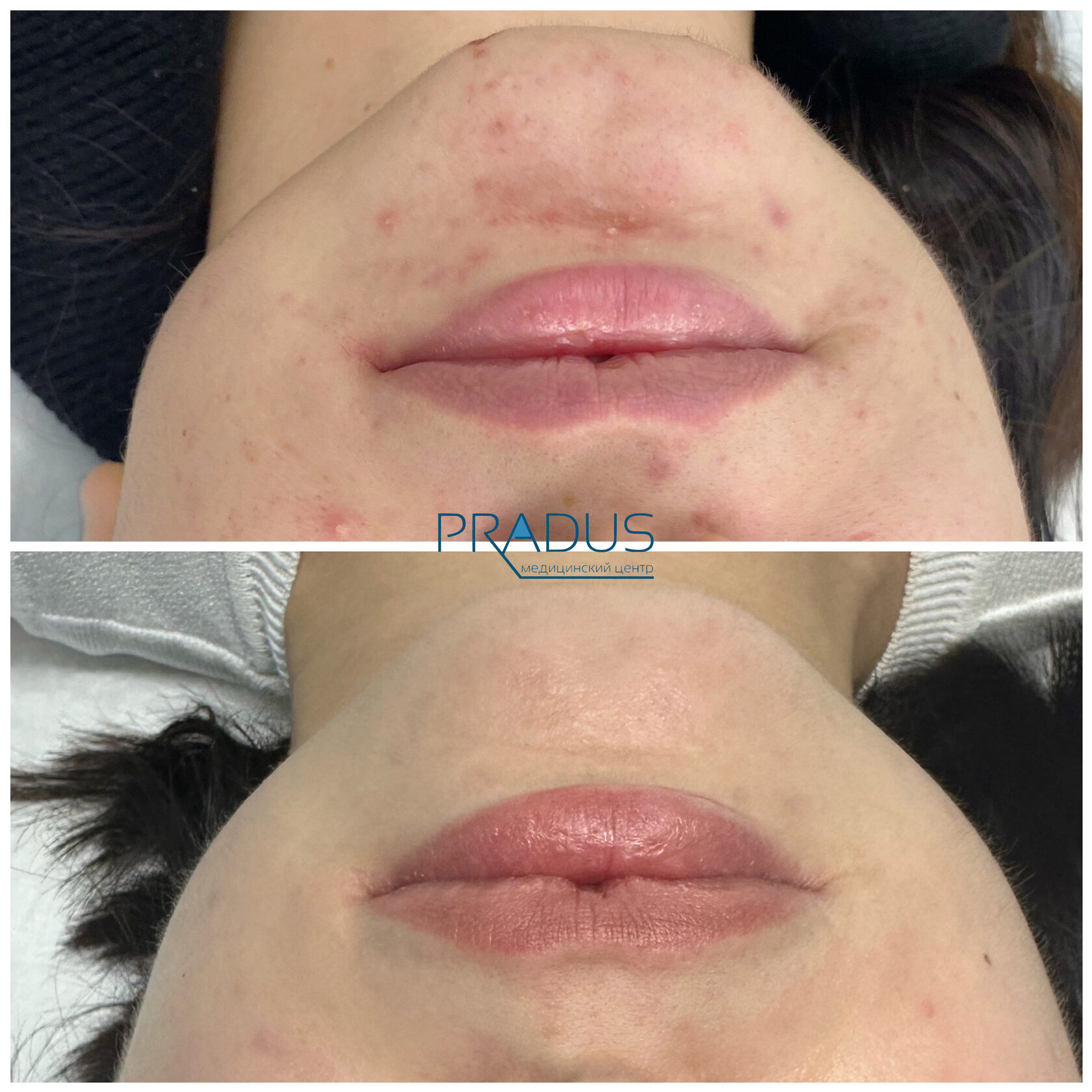 Лечение акне у женщины в клинике PradusCOSMO, СПб. До и после процедуры