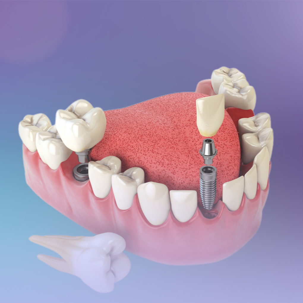 Ортопедическая стоматология, Стоматология Олимп, Качественные Протезы, Импланты