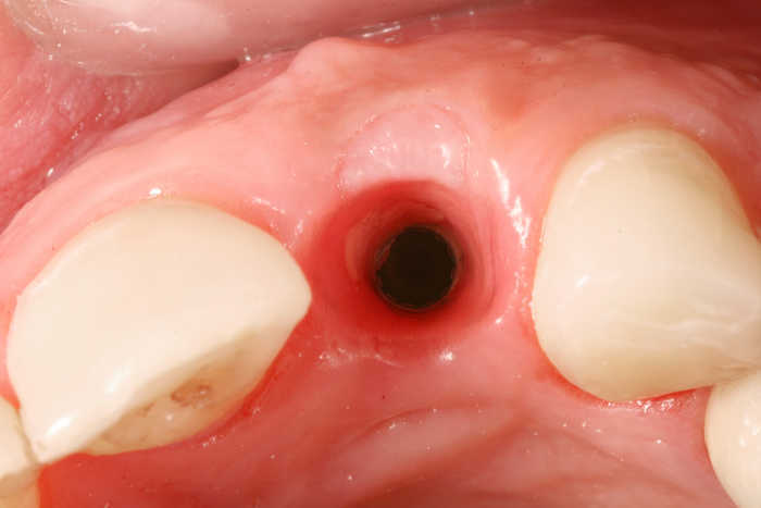 Возникновение эффекта сухой лунки после удаления зуба