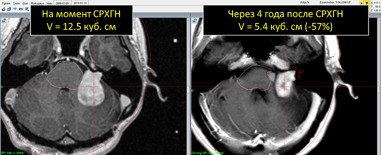 Удаление невриномы слухового нерва. Кибер нож невринома слухового нерва. Рецидив невриномы слухового. Невринома после гамма ножа. Гамма нож при невриноме слухового нерва.