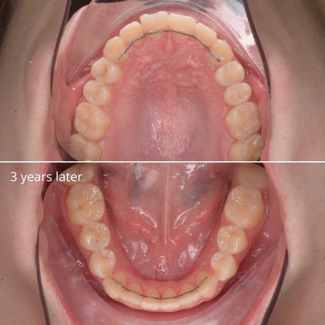 After treatment and three years later: stable, wide, even smile — photo 7 of 7