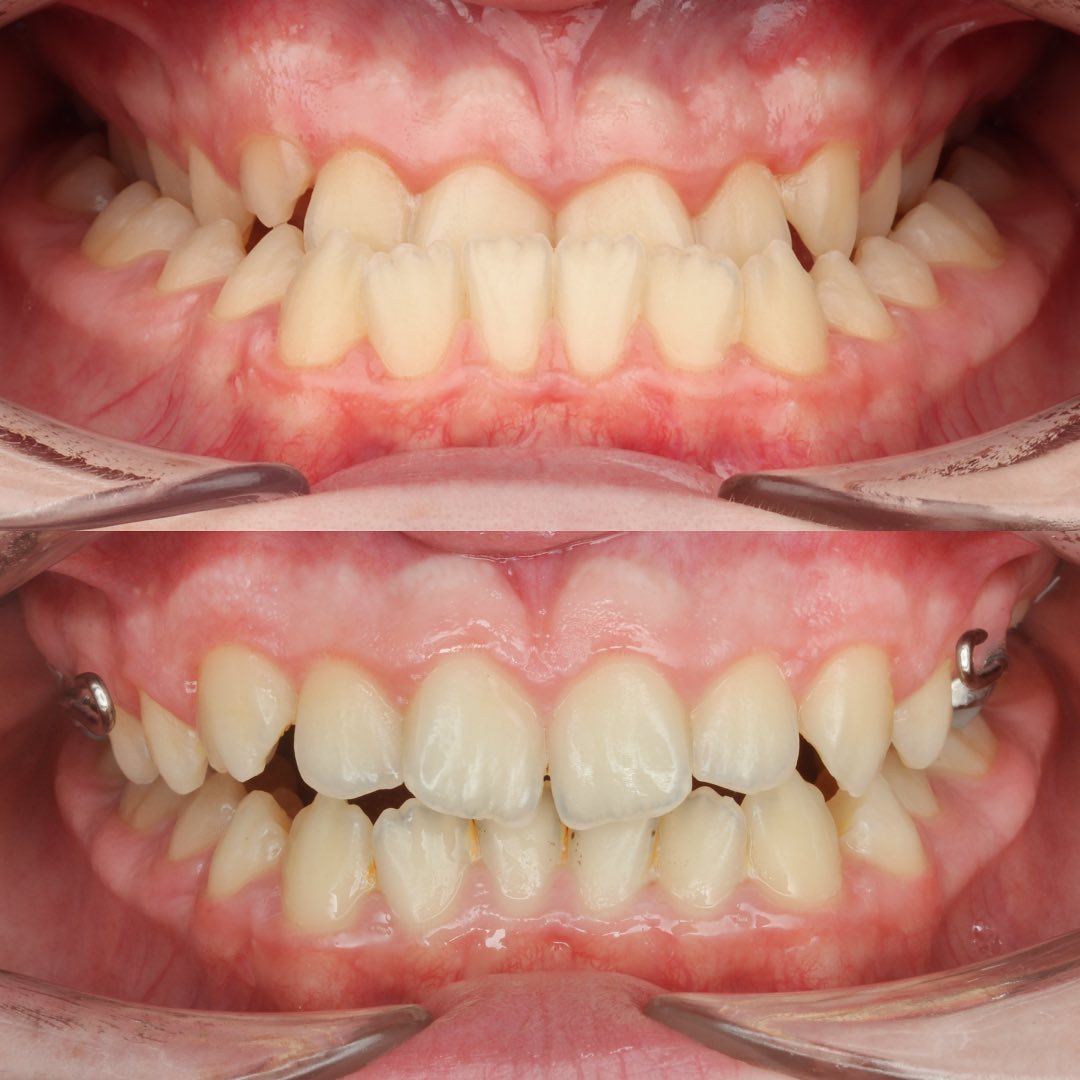 Before treatment view of the constricted maxillary arch prior to MARPE expansion