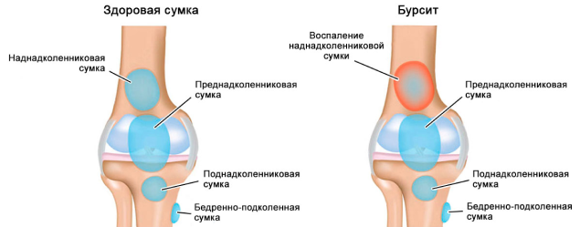 Воспаление жидкости. Скопление солей в коленях. Воспаление колена образование жидкости. Соли на суставах название.