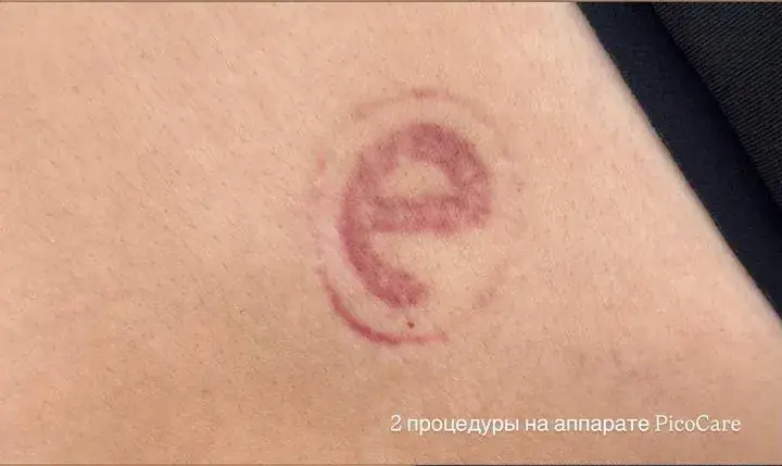 Красная татуировка-надпись, после