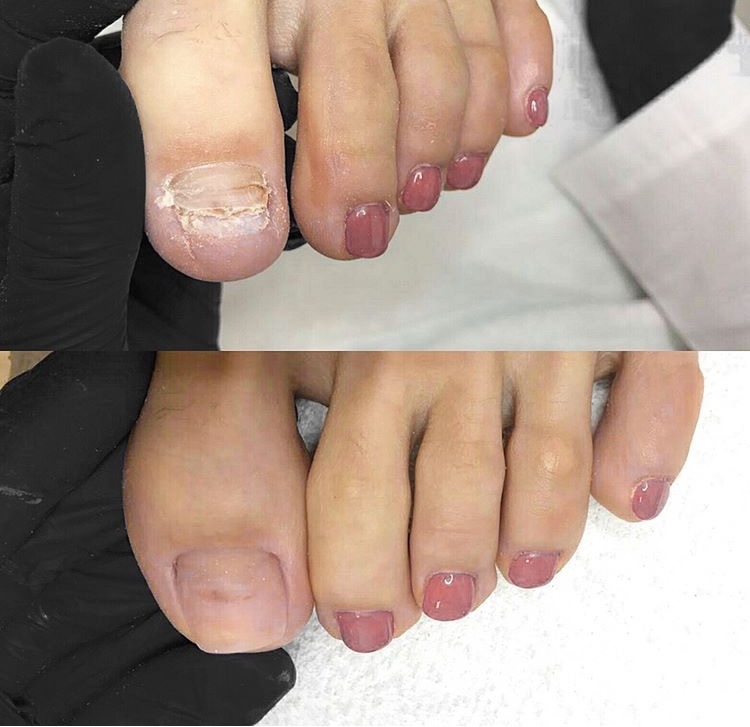 Лечение травмы ногтя на ноге: ушибы, гематомы – как лечить повреждения ногтя
