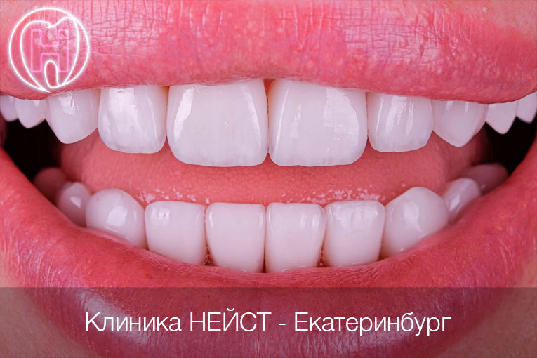 керамические виниры цвет Блич 3 (Bleach3)