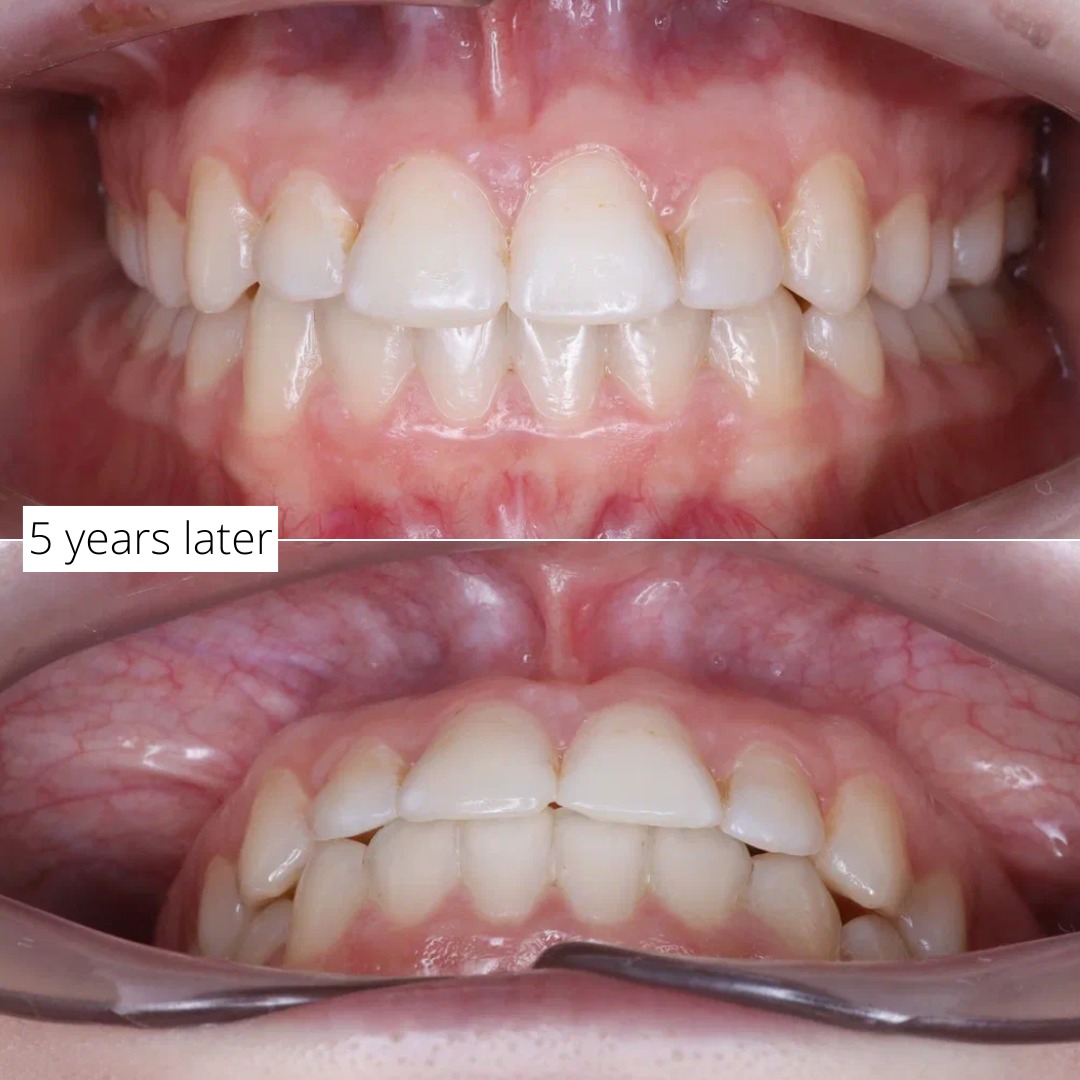 Mid-treatment view showing controlled transverse expansion of the crowded arches — photo 3 of 6
