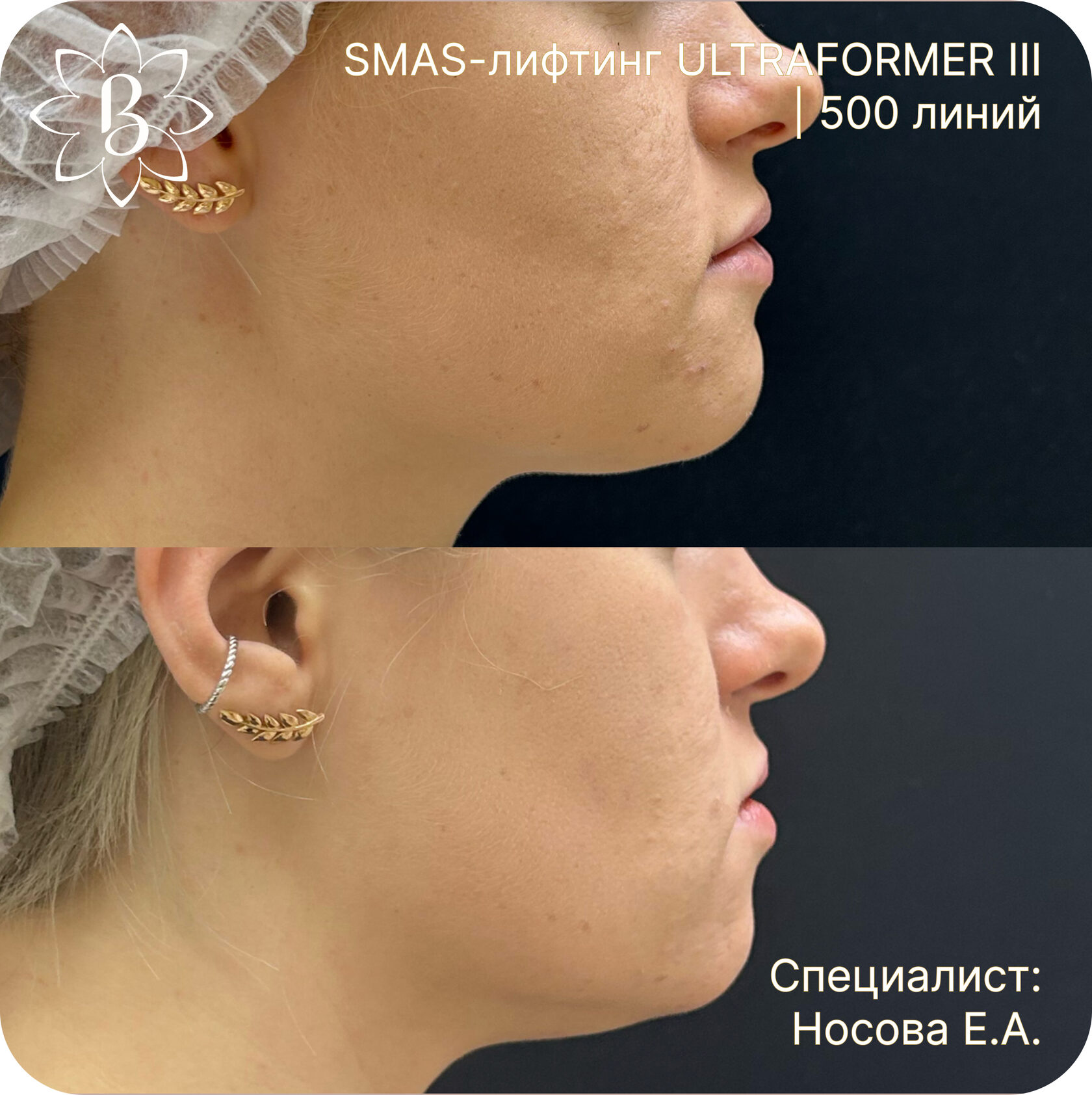 Александритовая лазерная эпиляция