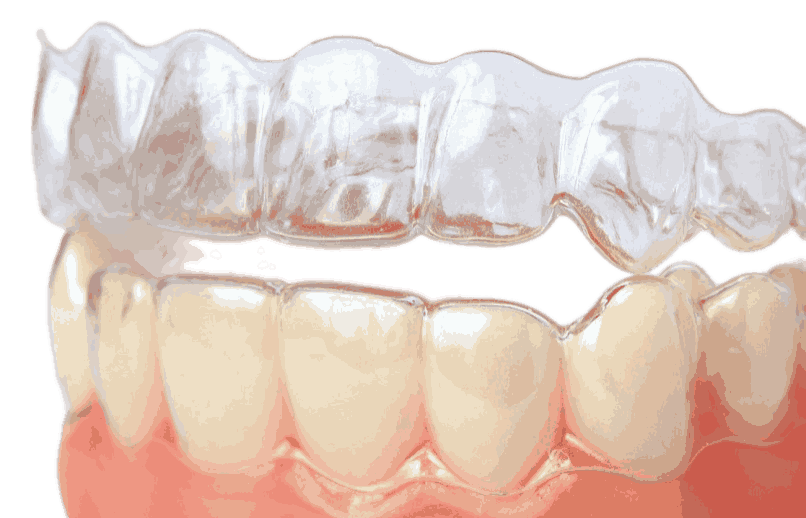 Протезы передних зубов в стоматологии Барышева ☎ +7 (908) 237-73-77 