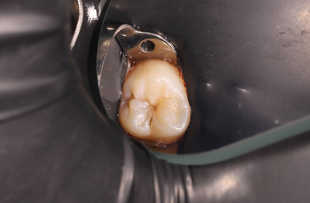 Реставрация жевательного зуба с устранением кариеса в фиссурах