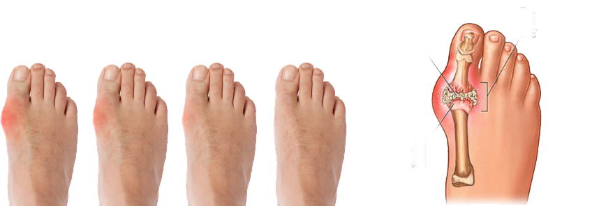 Болит большой палец на ноге: причины появления болей в пальце, симптомы заболеваний и лечение