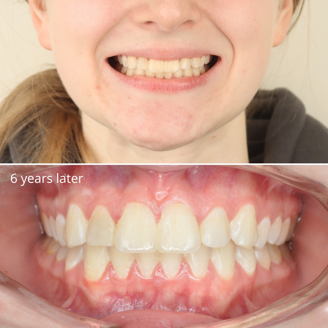 After photo showing a harmonious smile stable after six years of retention — photo 3 of 3