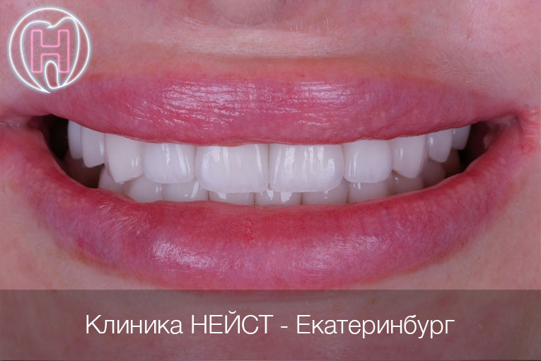 керамические виниры в Екатеринбурге цвет Блич 2 (Bleach2)