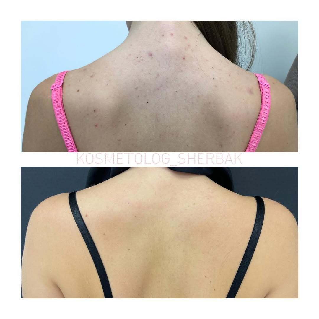 Лечение акне у женщины в клинике PradusCOSMO, СПб. До и после процедуры