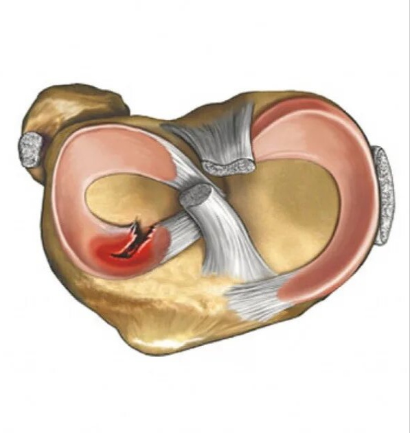 Повреждение мениска коленного сустава. Разрыв мениска коленного сустава анатомия. Воспаление мениска коленного сустава. Воспалился мениск на колене.