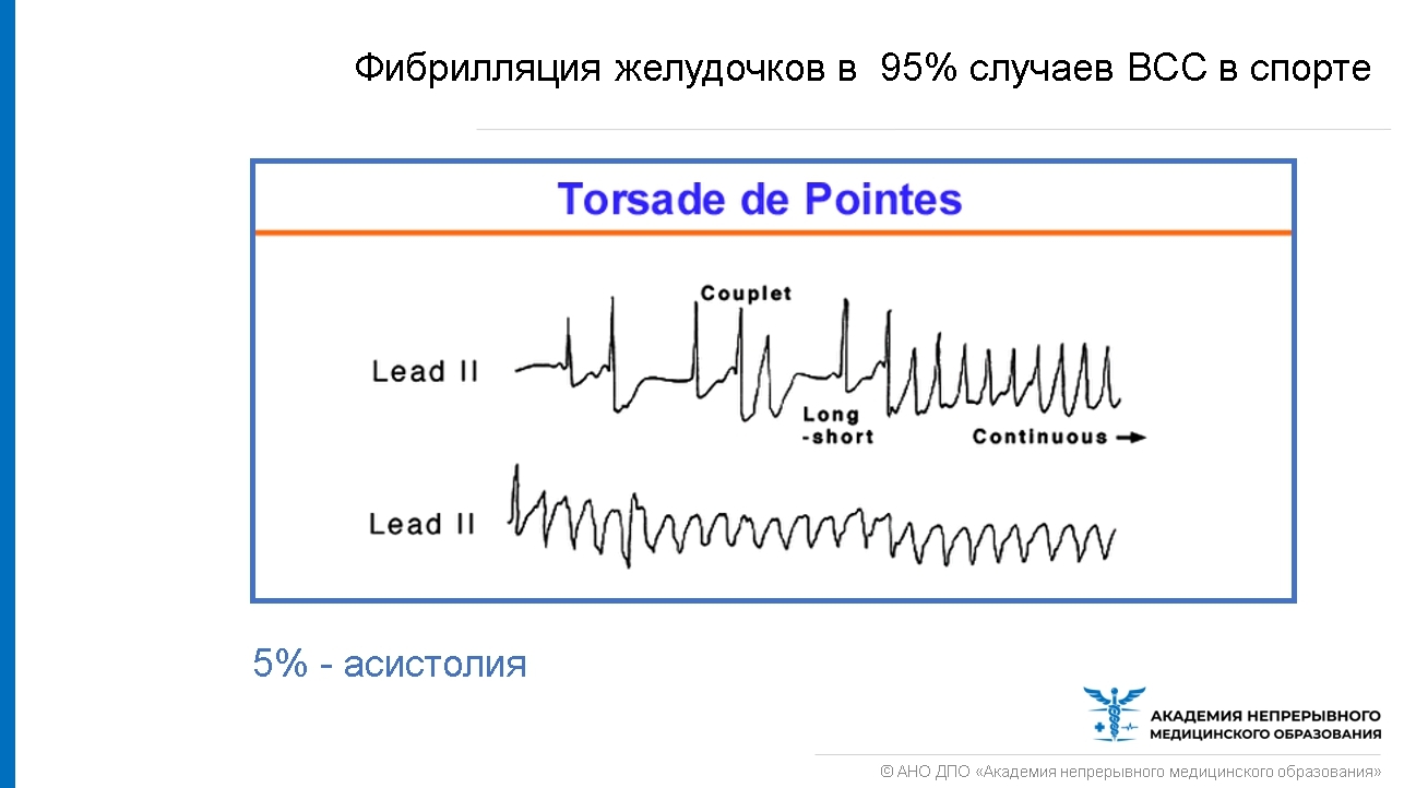 Патологическое спортивное сердце. Основные изменения