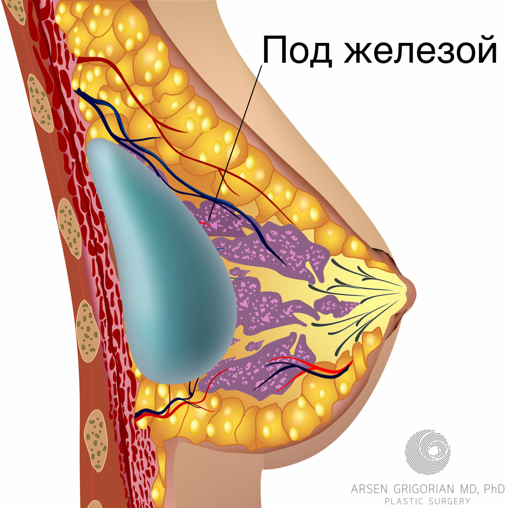 Увеличение груди