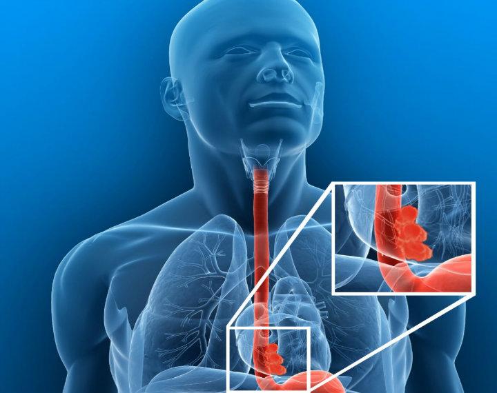 Рак пищевода и желудка онкология презентация