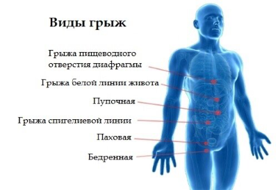 Пупочная грыжа у взрослых — как выглядит, симптомы, лечение