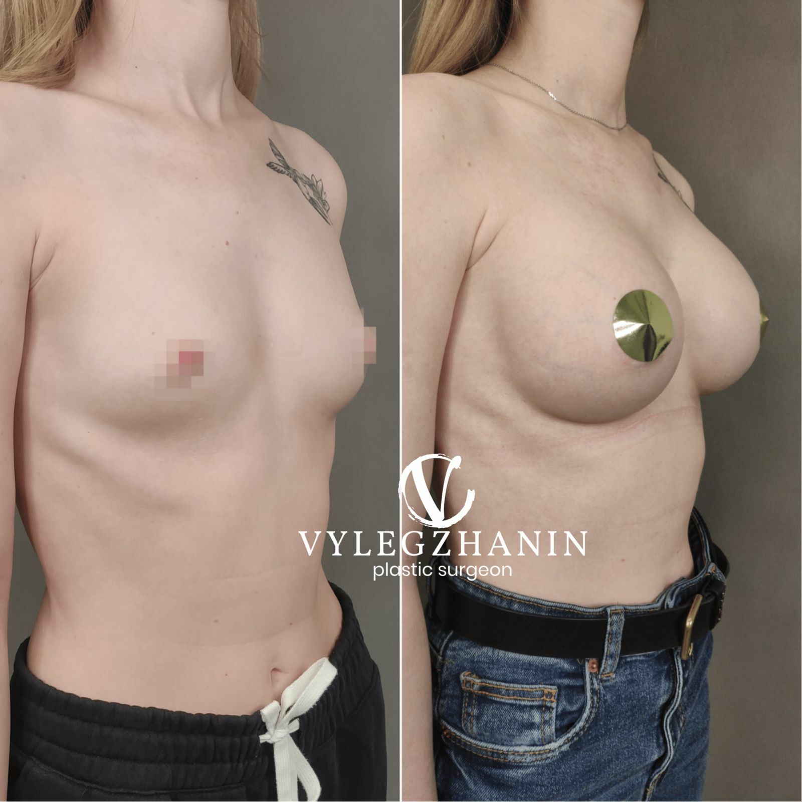 разные импланты на одну грудь фото 106