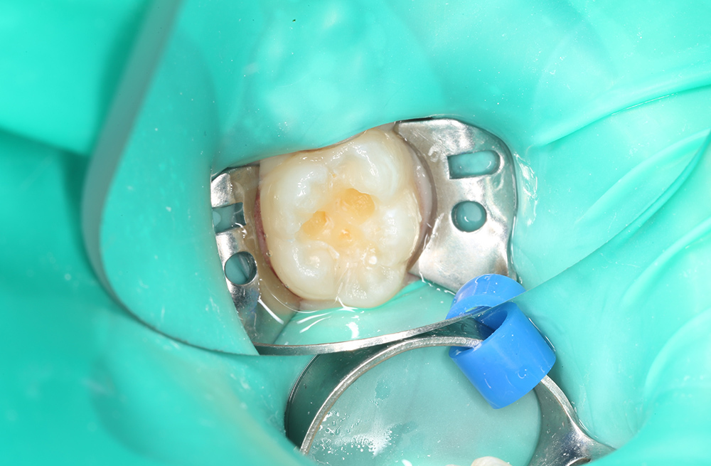 Диагностика и лечение скрытого кариеса на постоянном зубе у семилетнего ребёнка