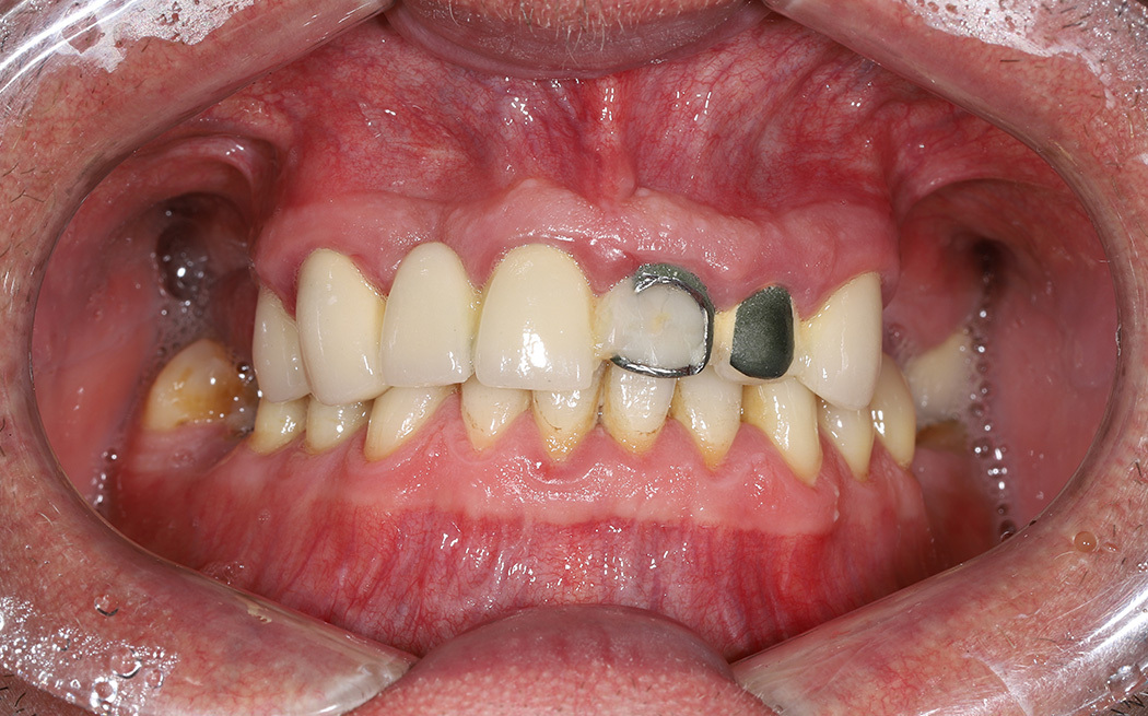 Имплантация зубов верхней челюсти (фронтальных и жевательных)