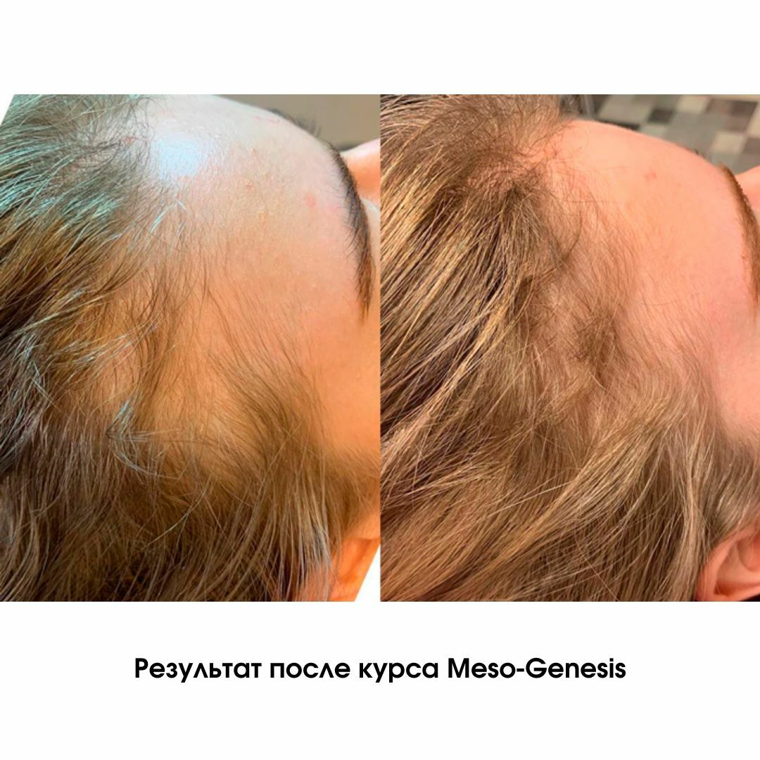 Мезотерапия для волос от выпадения