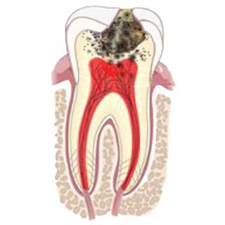 Периодонтит однокорневого зуба. Лечение периодонтита временного зуба. Лечение периодонтита временного зуба. Лечение периодонтита временного зуба. Воспаление зубного канала.