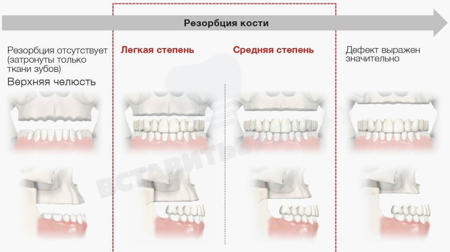 Скуловая имплантация фото