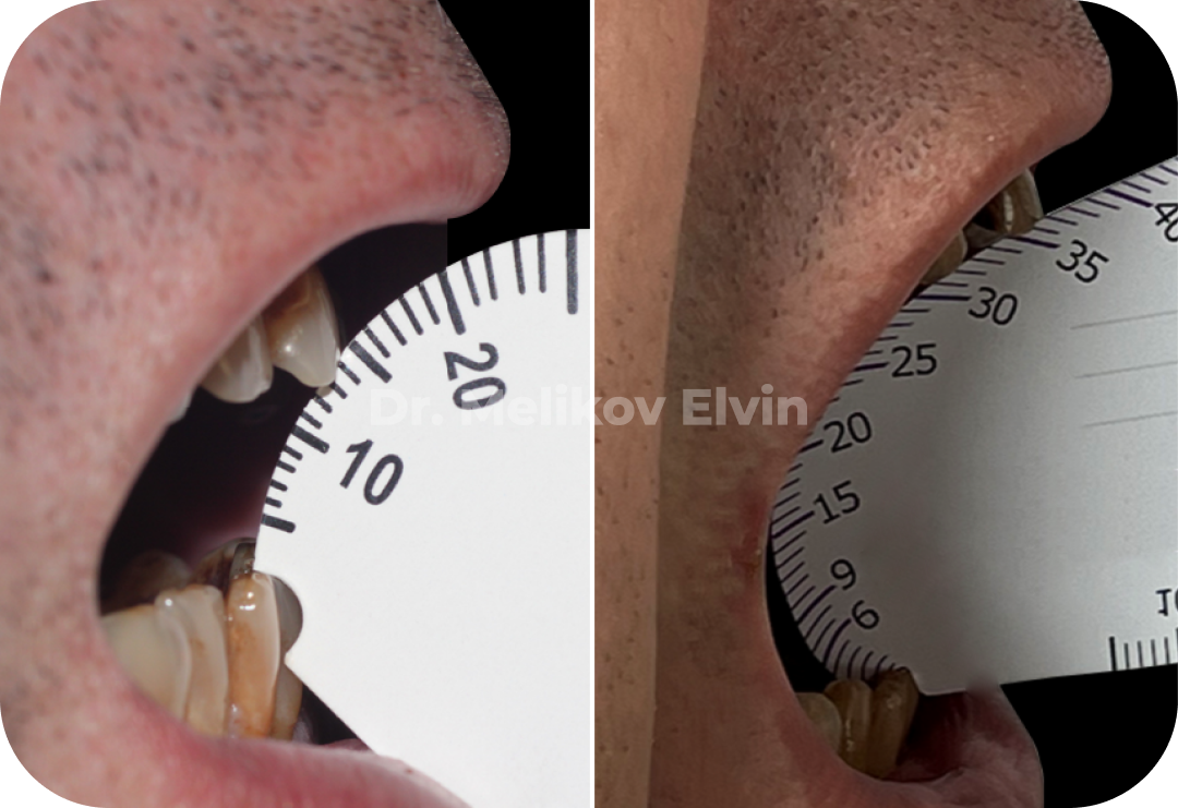 До и после эндопротезирования ВНЧС