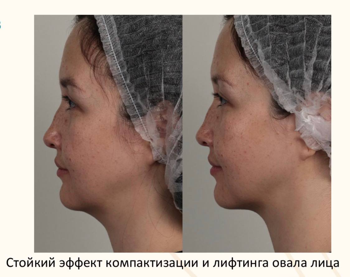 Профиль: компактизация и лифтинг овала