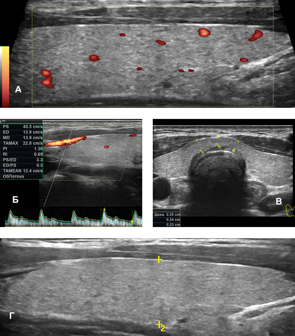 Щитовидная железа узи. Кровоток щитовидной железы УЗИ. Щитовидная железа УЗИ доплер. Снимок УЗИ щитовидной железы. УЗИ щитовидной железы с допплерографией.