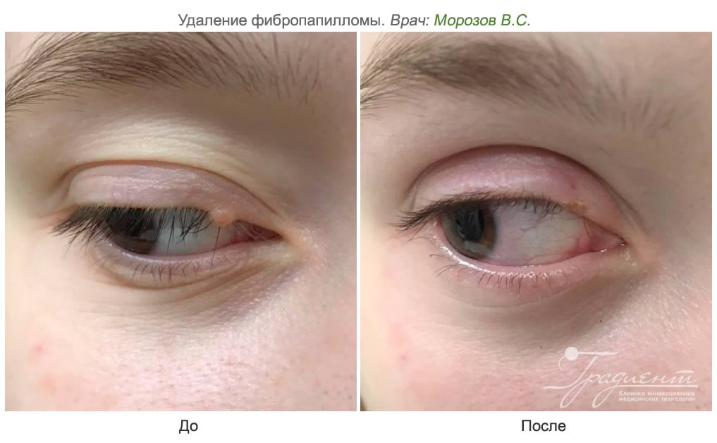Удаление жировика(липомы) с глаза | азинский.рф Однодневная Клиника