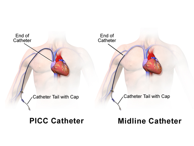 Central Catheters Safer Than PICCs For Short-Term Venous Access: JAMA