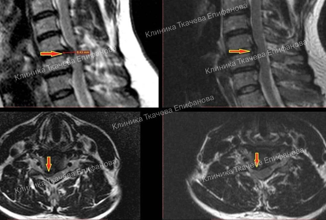 Грыжа шейного отдела с7 лечение