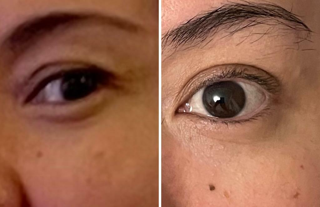 Dermaheal eyebag solution до и после. Пигментация вокруг глаз. Мезотерапия кожи вокруг глаз. Тонкая кожа вокруг глаз.