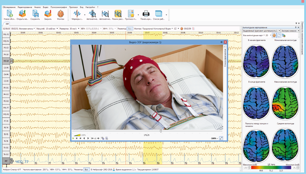 ЭЭГ мониторинг головного мозга. ЭЭГ аппарат Нейрон-спектр-5. ЭЭГ ночной сон видеомониторинг. Видеомониторинг ЭЭГ ребенку.