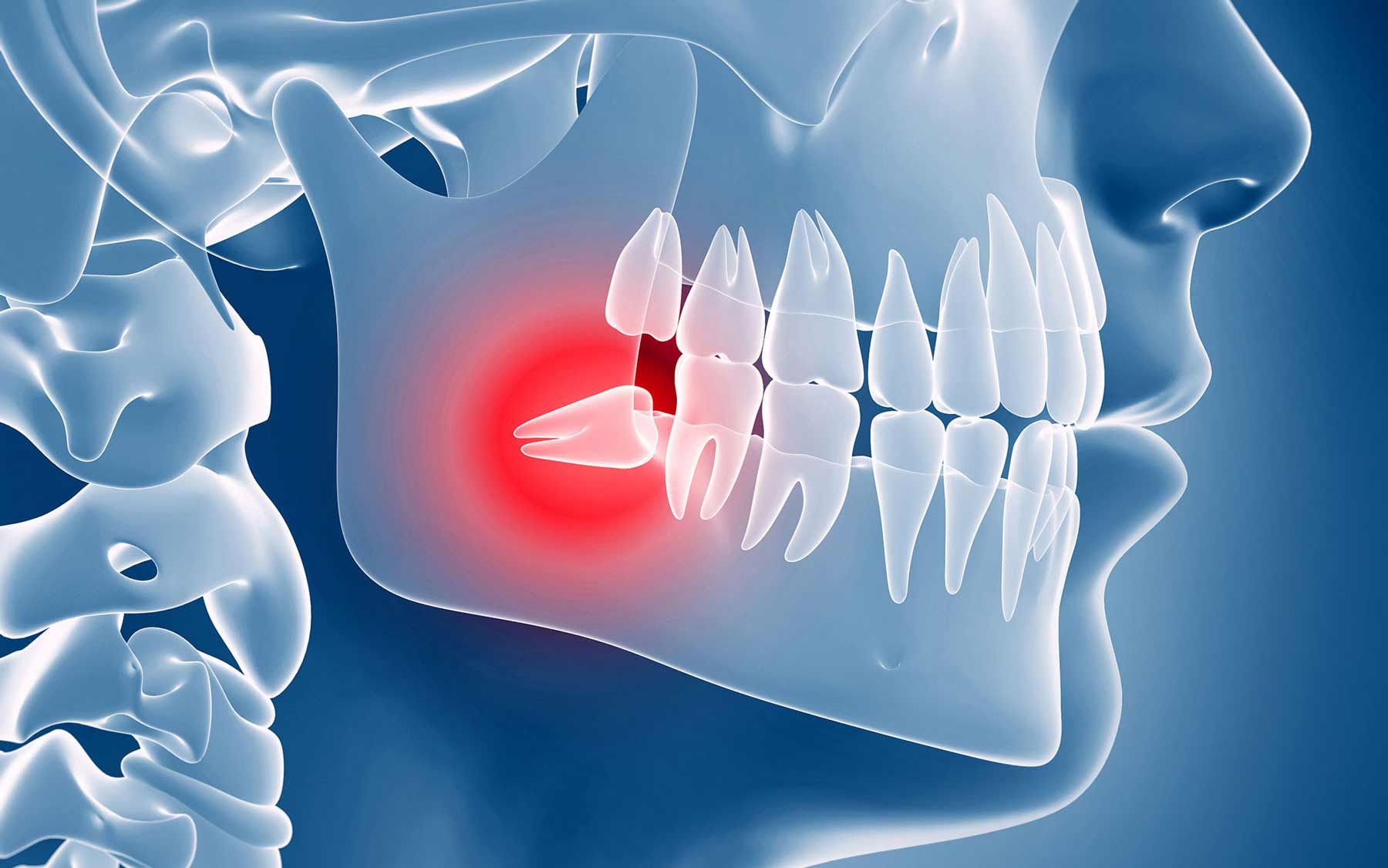 зубная боль зуб мудрости стоматология москва